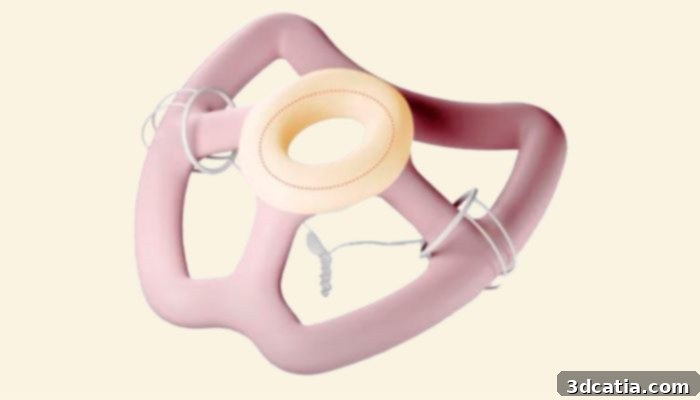 FemTherapeutics custom 3D printed pessary