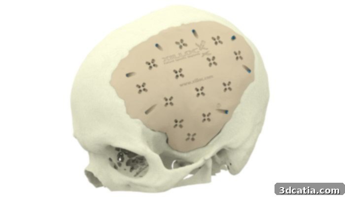 A PEEK cranial implant. (Photo Credit: Xilloc Medical)