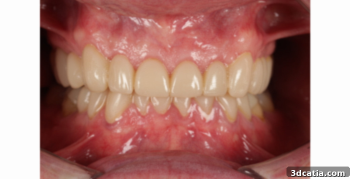 The final product showcases the power of 3D printing within the dental sector.