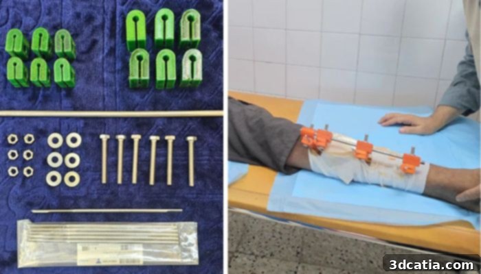 Kit with metal parts and 3D-printed components; patient with the external fixator.