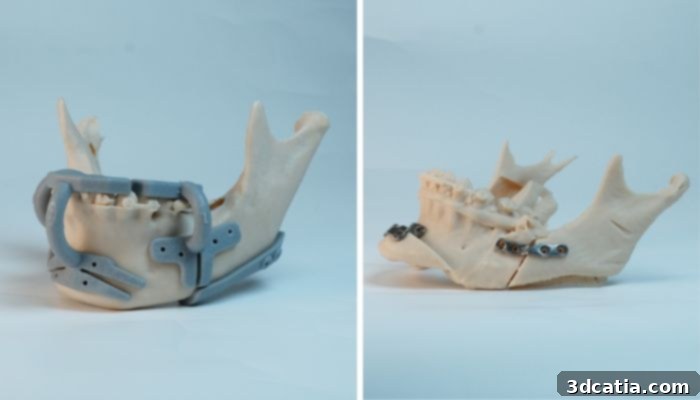 Genioplasty Surgical Guide